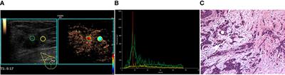 Contrast-enhanced ultrasound for the preoperative prediction of pathological characteristics in breast cancer